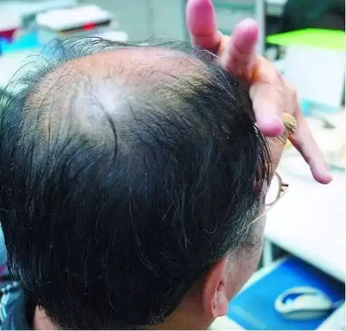 长不长寿,头发会报信过了50岁,秃头的人更长寿答案很意外

