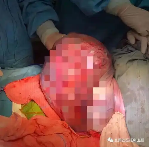 良乡医院为一年近八旬老太摘除巨大卵巢肿瘤这点提醒请一定记好
